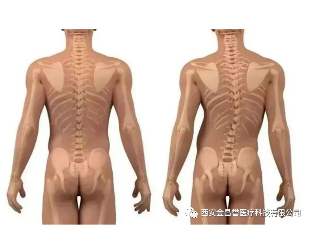 青少年脊柱側(cè)彎科普月，金昌譽(yù)與您一同守護(hù)青少年脊柱健康